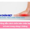 Hướng dẫn cách chữa bàn chân bẹt ở trẻ em trong vòng 2 tháng