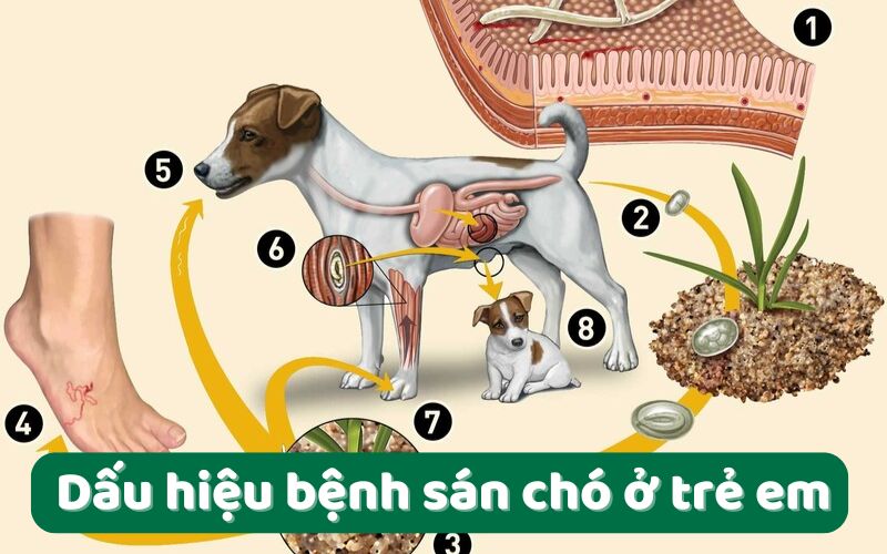 Dấu hiệu bệnh sán chó ở trẻ em