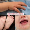 Dấu hiệu nhận biết bệnh tay chân miêng ở trẻ em