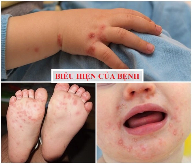 Dấu hiệu nhận biết bệnh tay chân miêng ở trẻ em