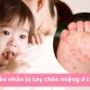 Nguyên nhân bị tay chân miệng ở trẻ em