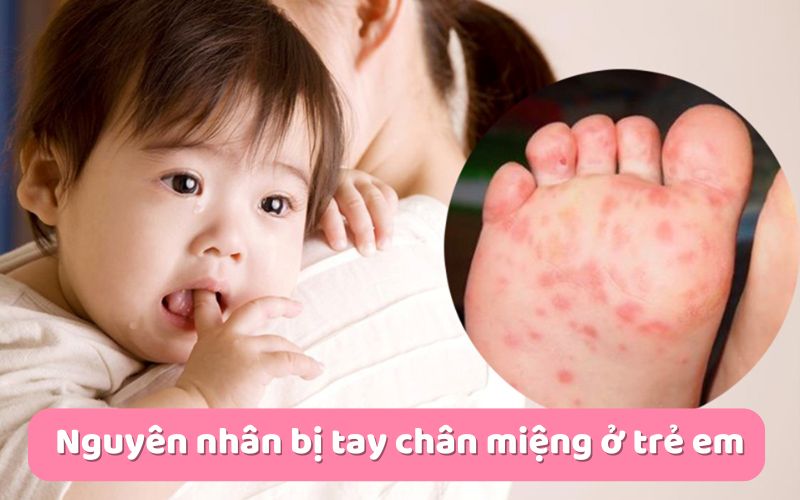 Nguyên nhân bị tay chân miệng ở trẻ em